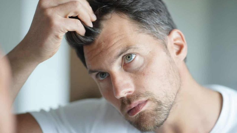 Φαλάκρα στους άντρες: Πες αντίο στην αραίωση των μαλλιών